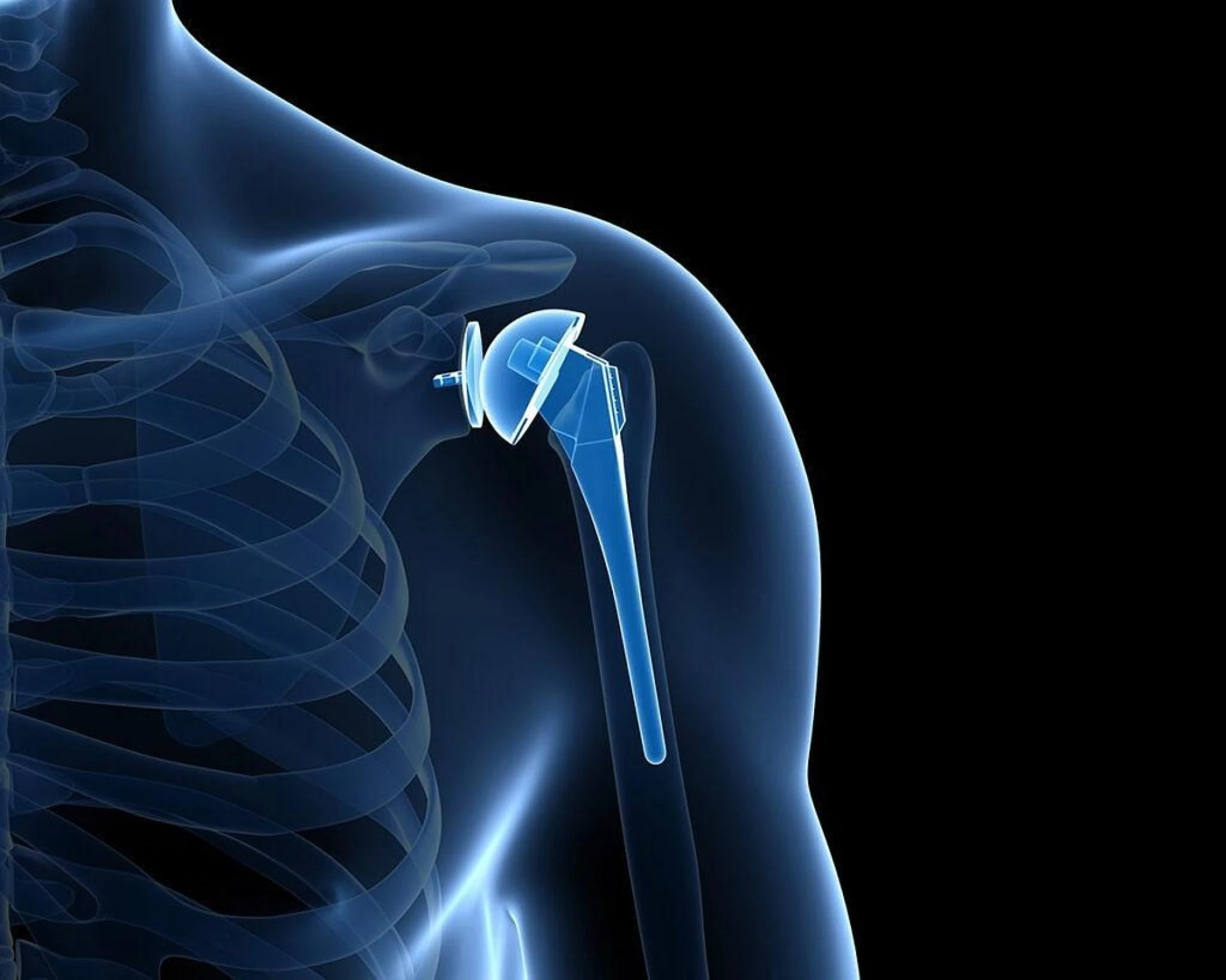 Living Without Shoulder Pain: A Guide to Total Shoulder Replacement Surgery in Delhi
