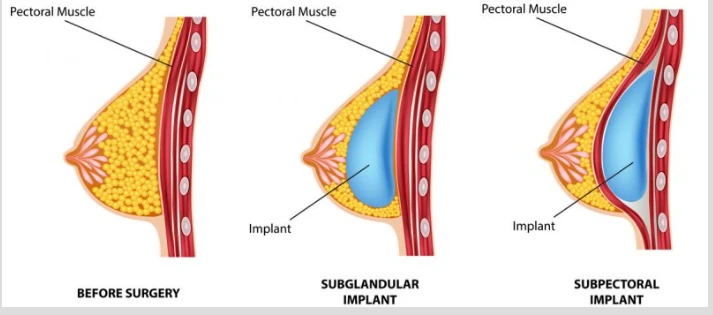 Breast Implants in Ludhiana | Safe Cosmetic Enhancement