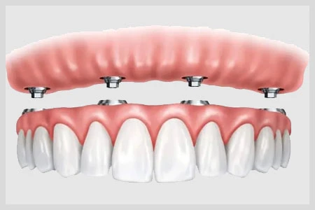 Recovery and Healing After Full Arch Dental Implants 