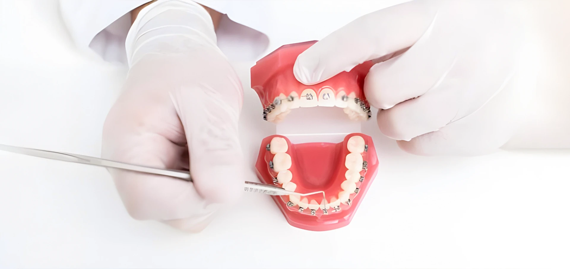 Teeth Gap Fixing Alternatives to Braces in Gurgaon & Delhi Clinics | The Dental Roots