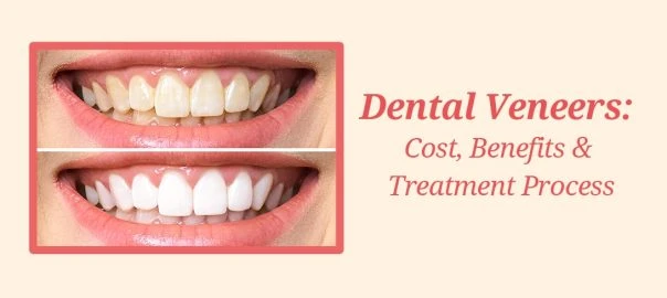 Are denture veneers painful? 