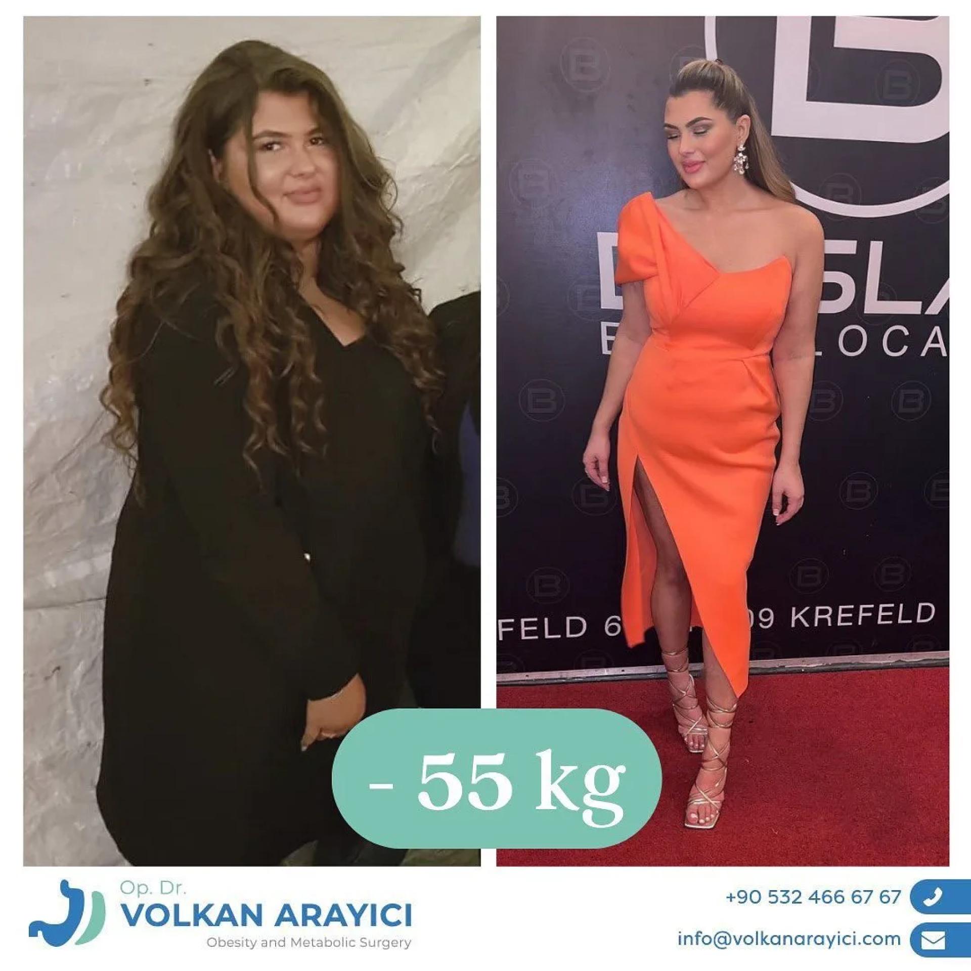 How to Choose the Best Gastric Sleeve in Turkey for Safe Weight Loss