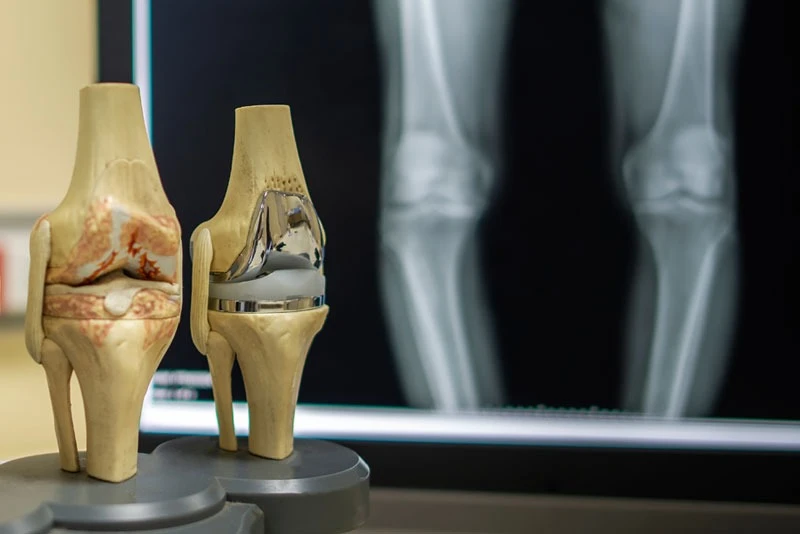 Post-Surgery Care and Recovery After Joint Replacement Surgery in Delhi