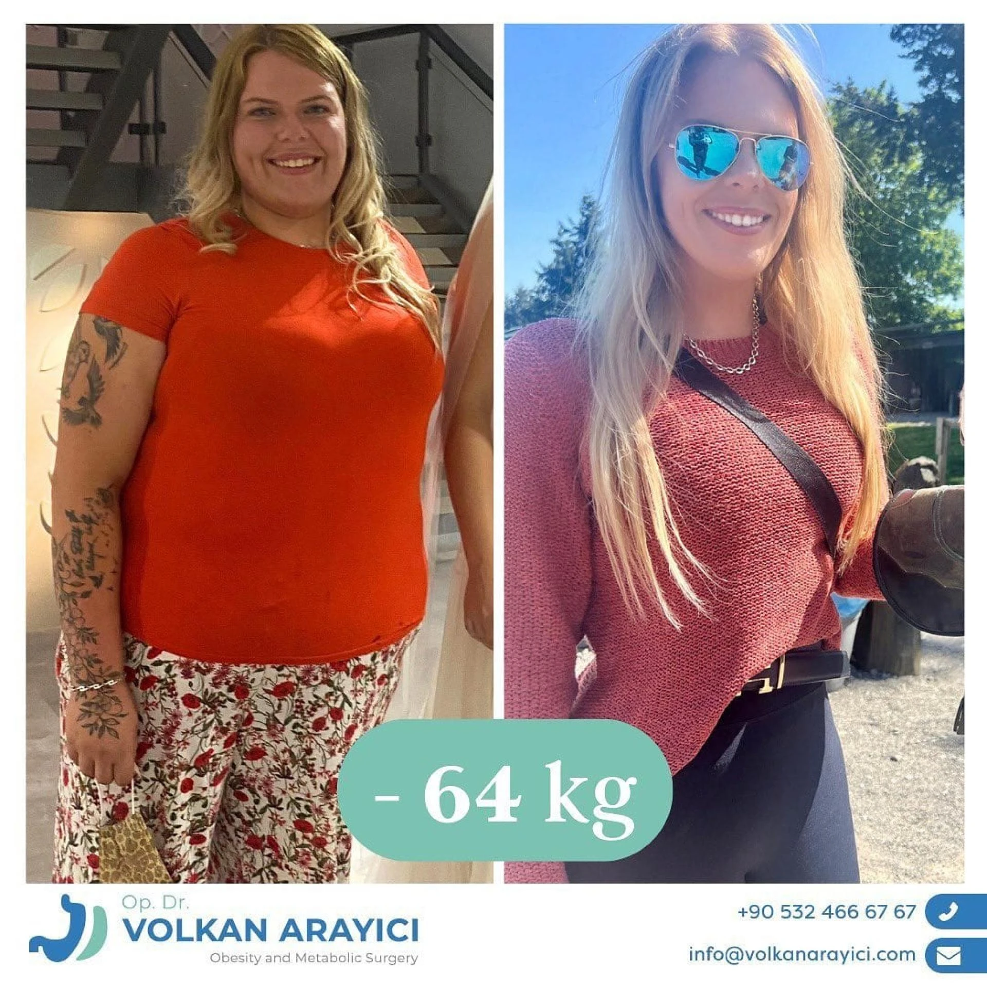 Obezite Ameliyatı Türkiye’de: Sağlık Turizmi ve Başarı Oranları