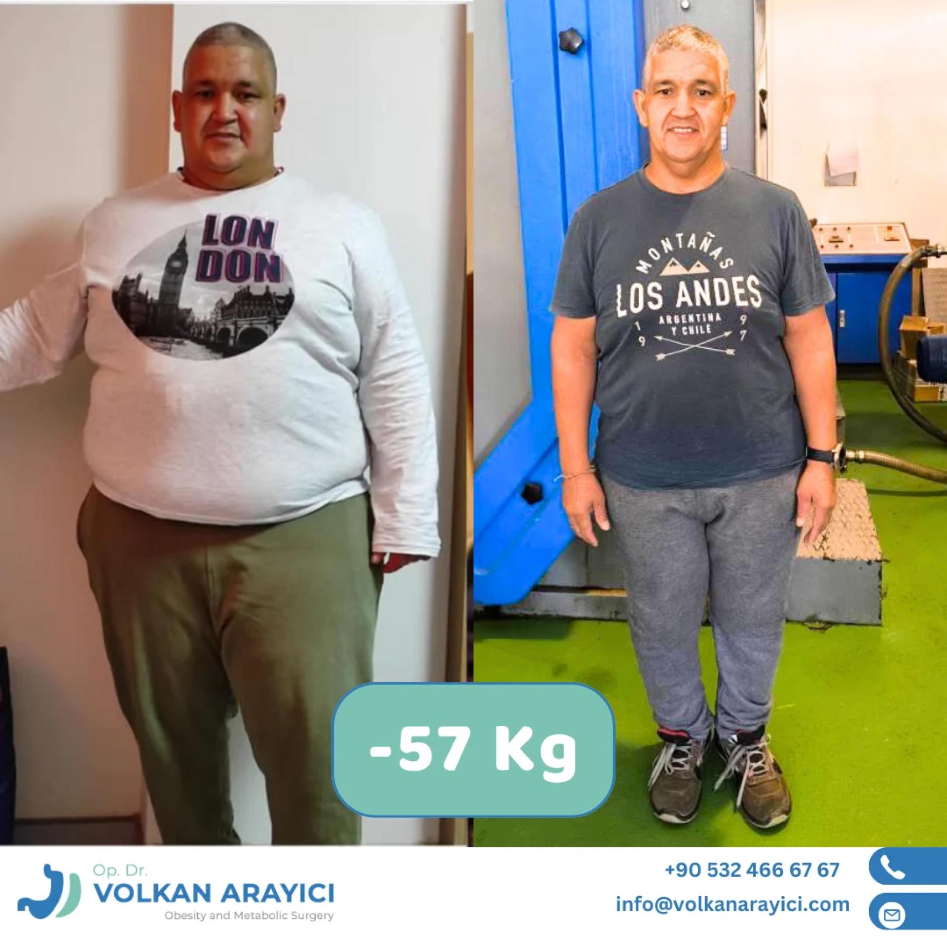 Precio de la manga gástrica en Turquía: costos, comparaciones y beneficios