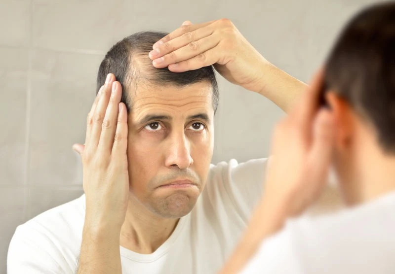 Advanced Hair Loss Treatment Delhi for Pattern Baldness and Alopecia