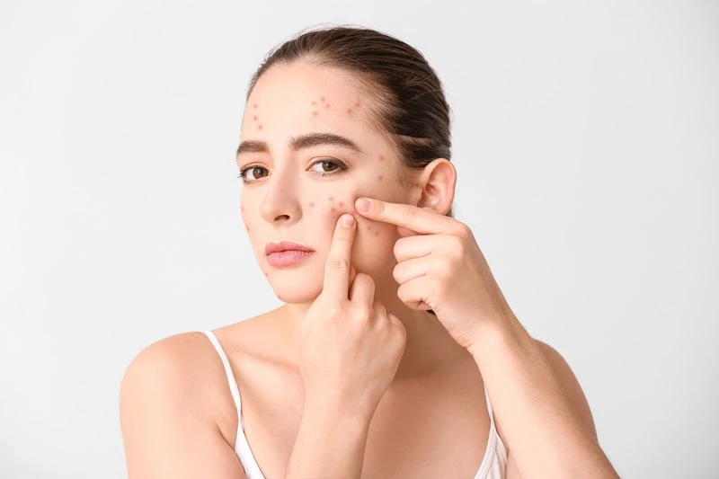 Acne Scar Treatment in Delhi: Types, Causes, and Advanced Solutions at Derma Station