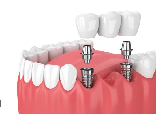 Signs You Might Need a Dental Bone Graft Before Getting Implants