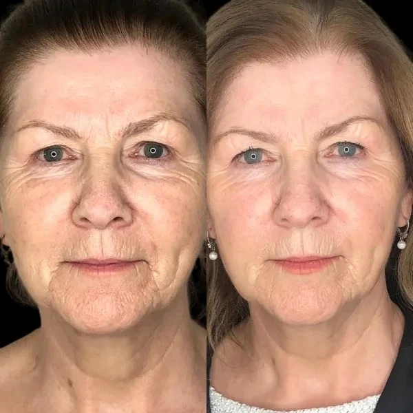 Clarity Takes Form with Profhilo Treatments in Dubai