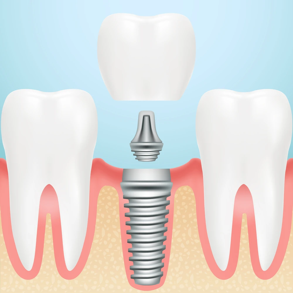 Why Miami Is a Top Destination for Advanced Dental Implant Treatment
