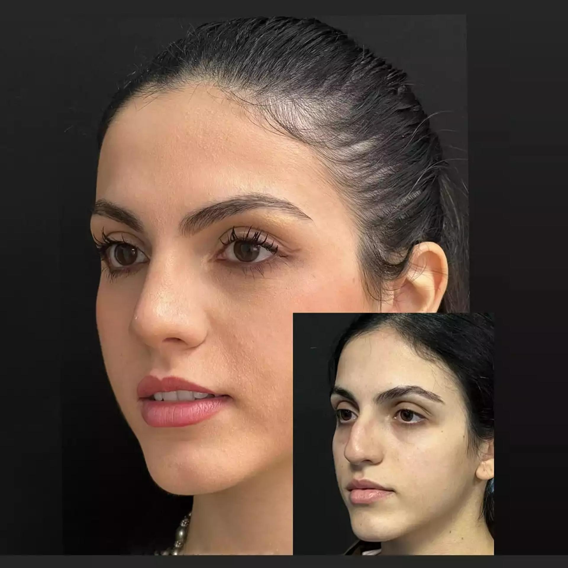Best Rhinoplasty Surgeon in Dubai for Natural and Balanced Results