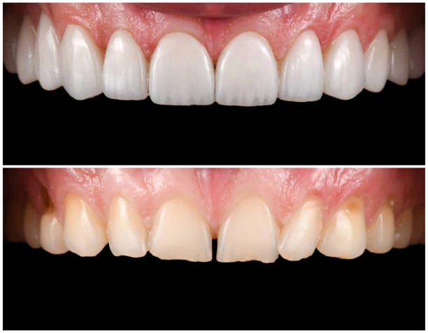 6 Subtle Ways Veneers Change More Than Just Your Smile