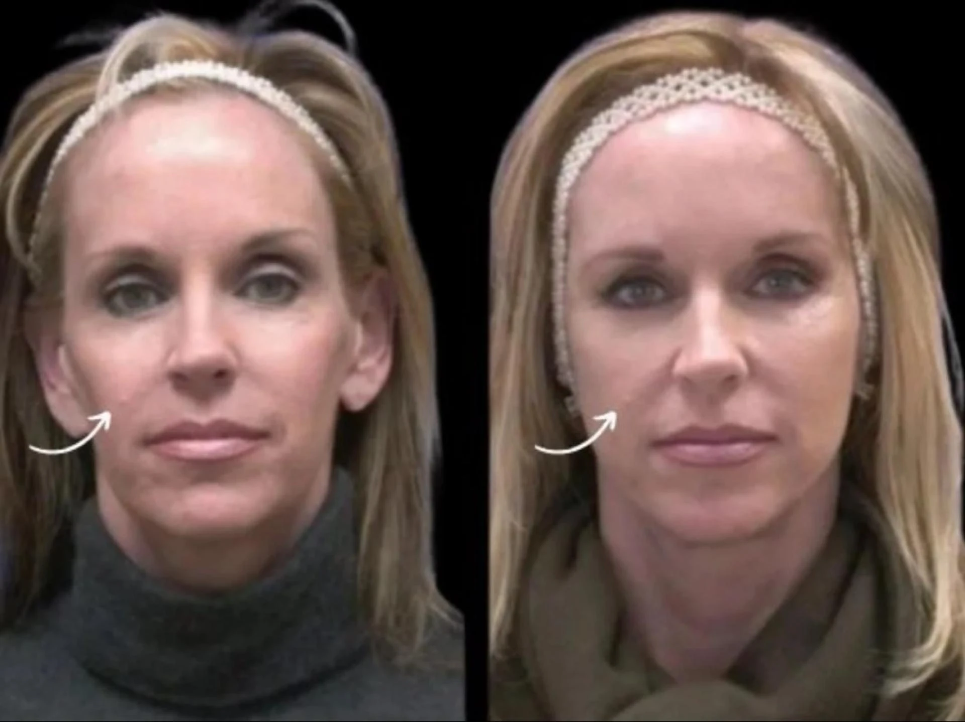Best Aesthetic Clinic in Dubai for Sculptra Fillers Invisible Volume