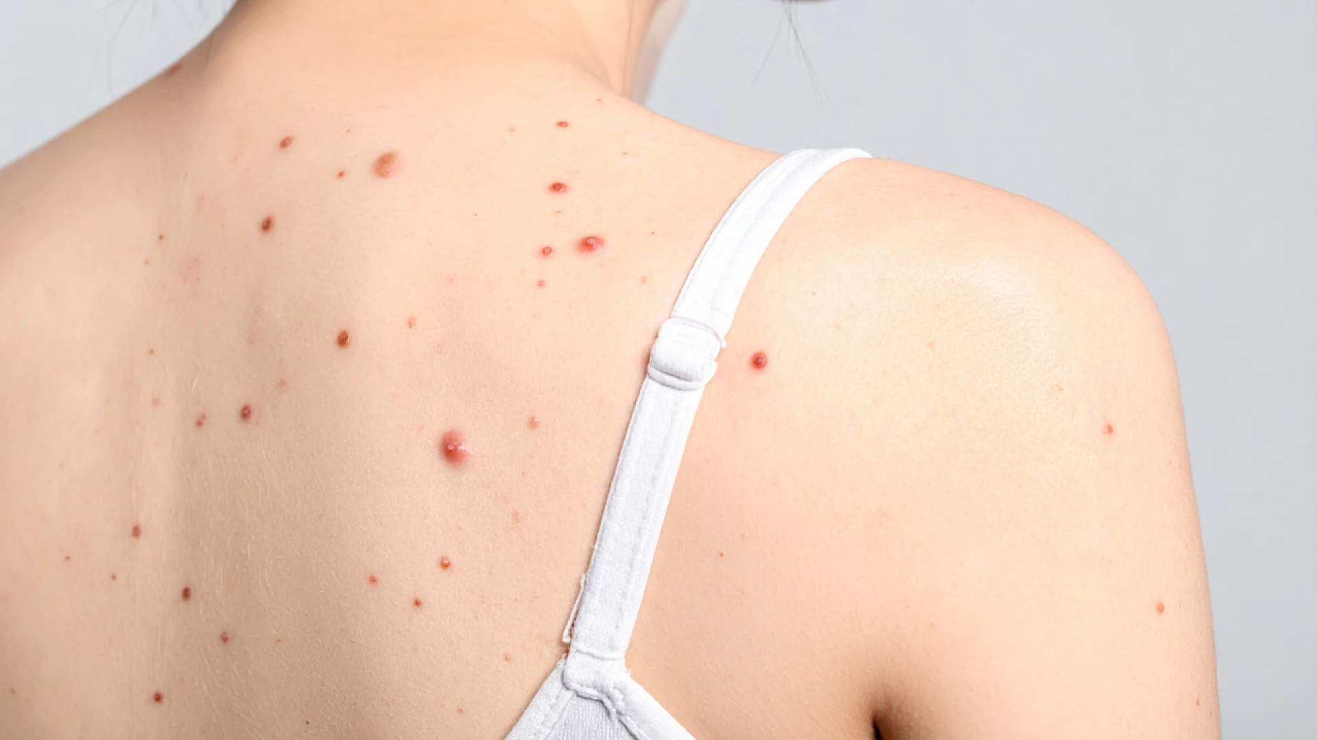 Antifungal Skin Medication: Types, Uses, and Treatment Duration