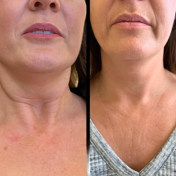 Profhilo Expertise by the Best Plastic Surgeons in Dubai