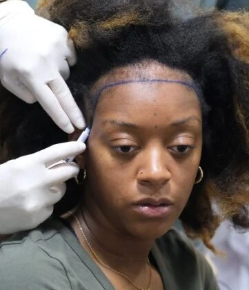 Women Hair Transplant Turkey: Safe and Effective Solutions