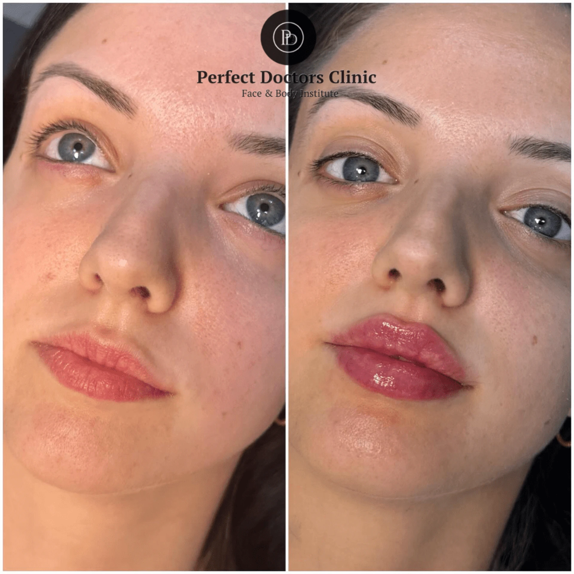 Why Experience Matters for Juvederm with the Best Plastic Surgeon in dubai
