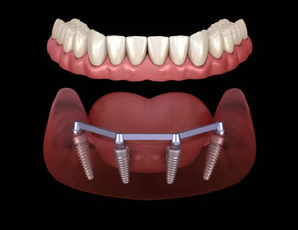 Is Dental Implant Treatment Painful? What Patients Should Know