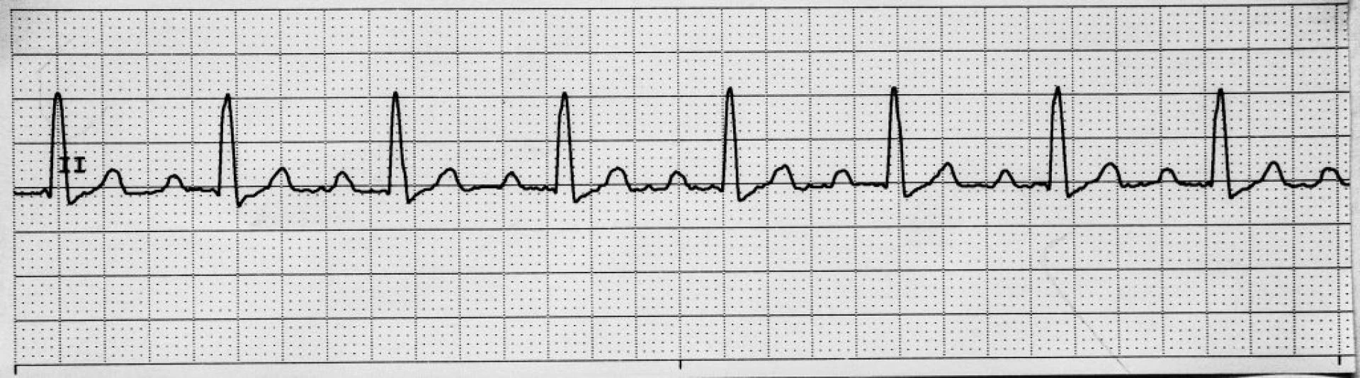 Smartwatches vs ECG – What They Miss