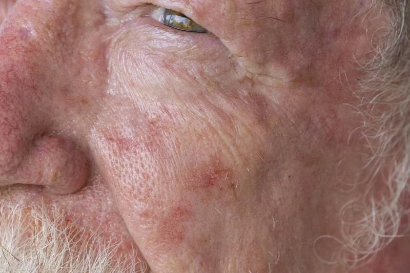 Dermatology Fort Worth Specialists Offering Mohs Surgery and Advanced Skin Care