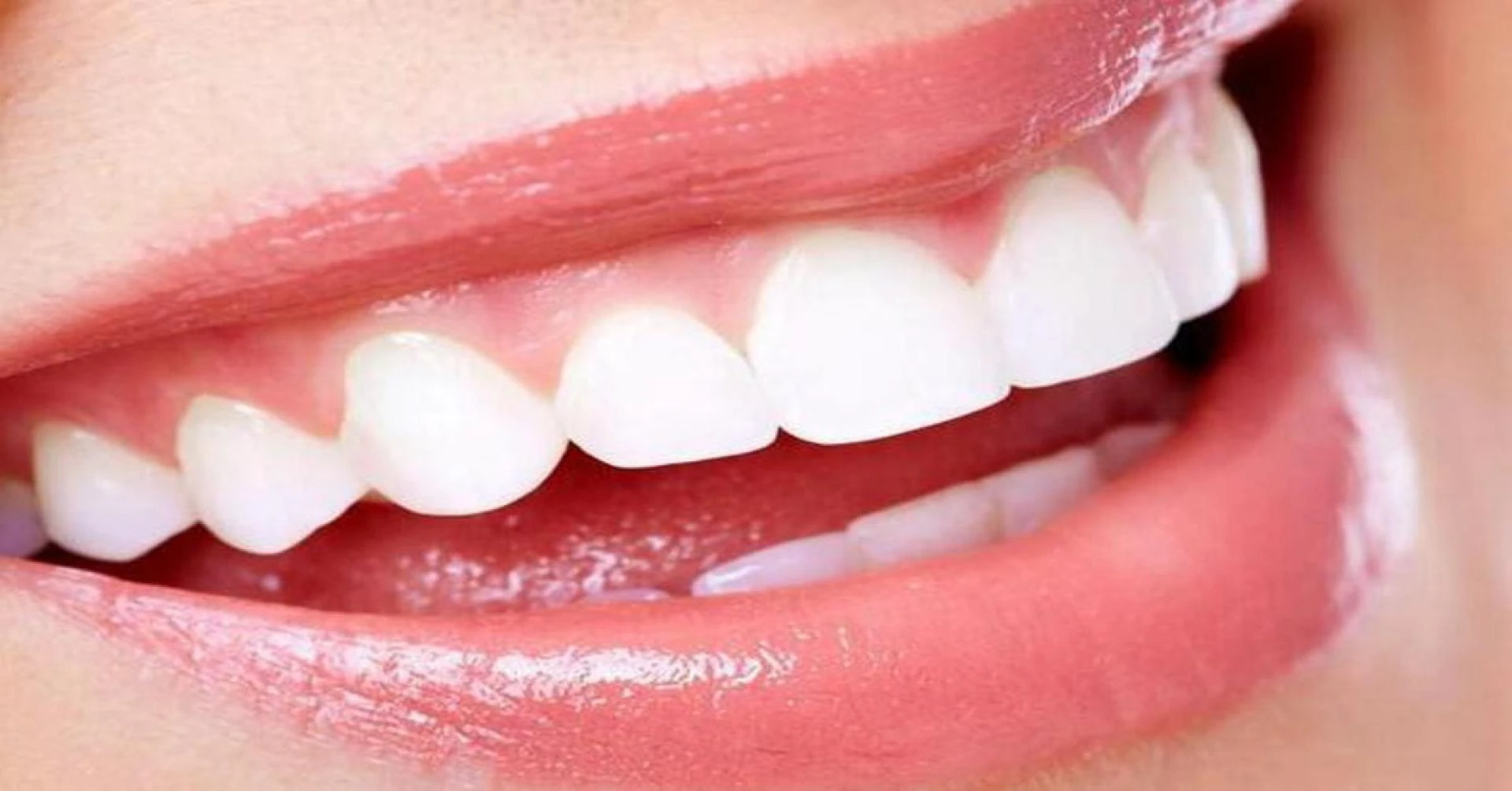 Teeth Whitening in Dubai: Brighten Your Smile Safely and Effectively