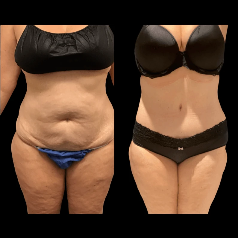 How do I prepare my skin for liposuction in Dubai?
