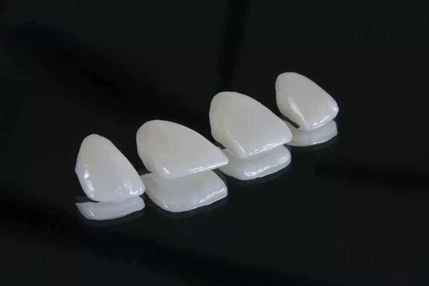 Things to Consider Before Getting Veneers