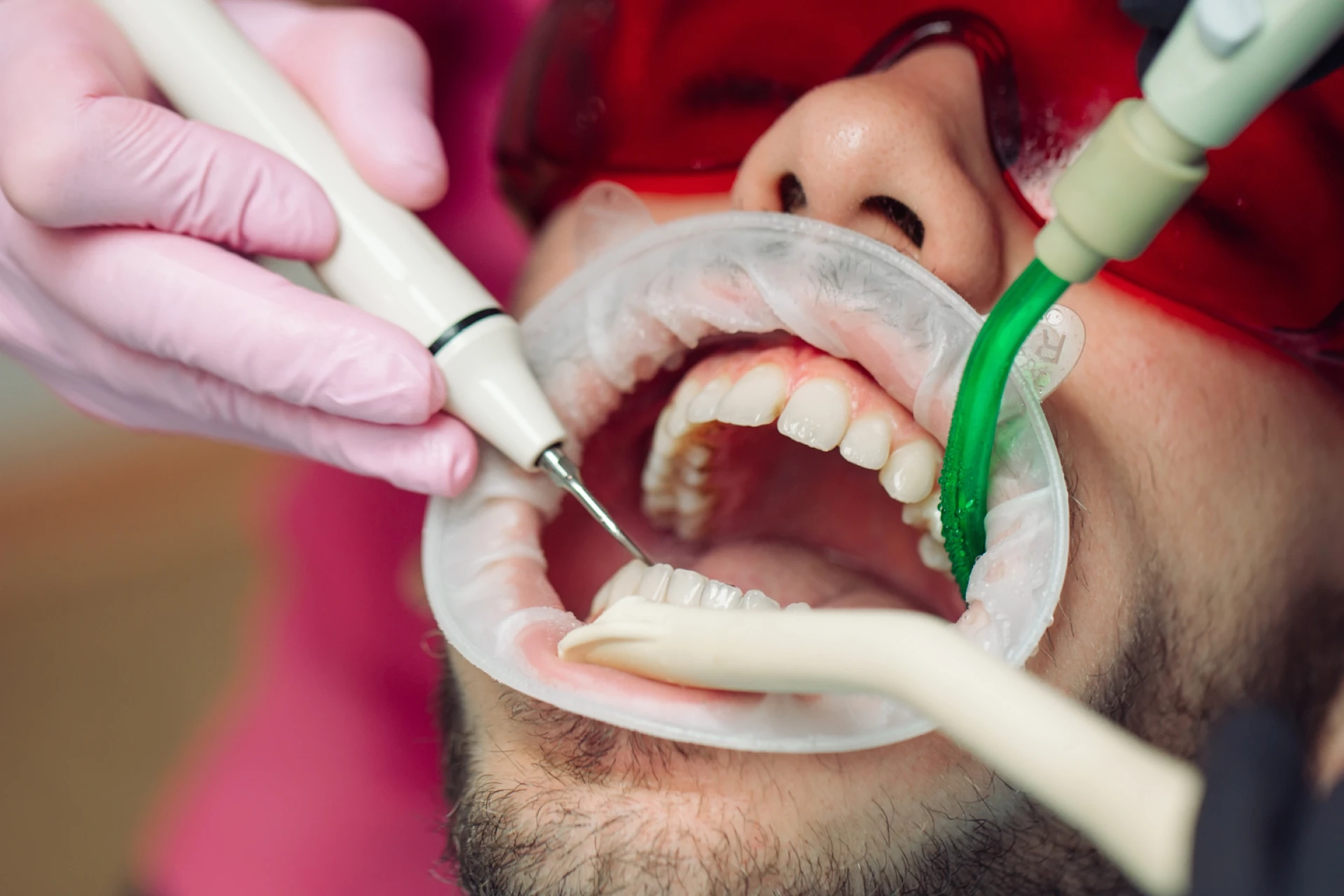 The Hard Truth About Tartar: Understanding Dental Calculus