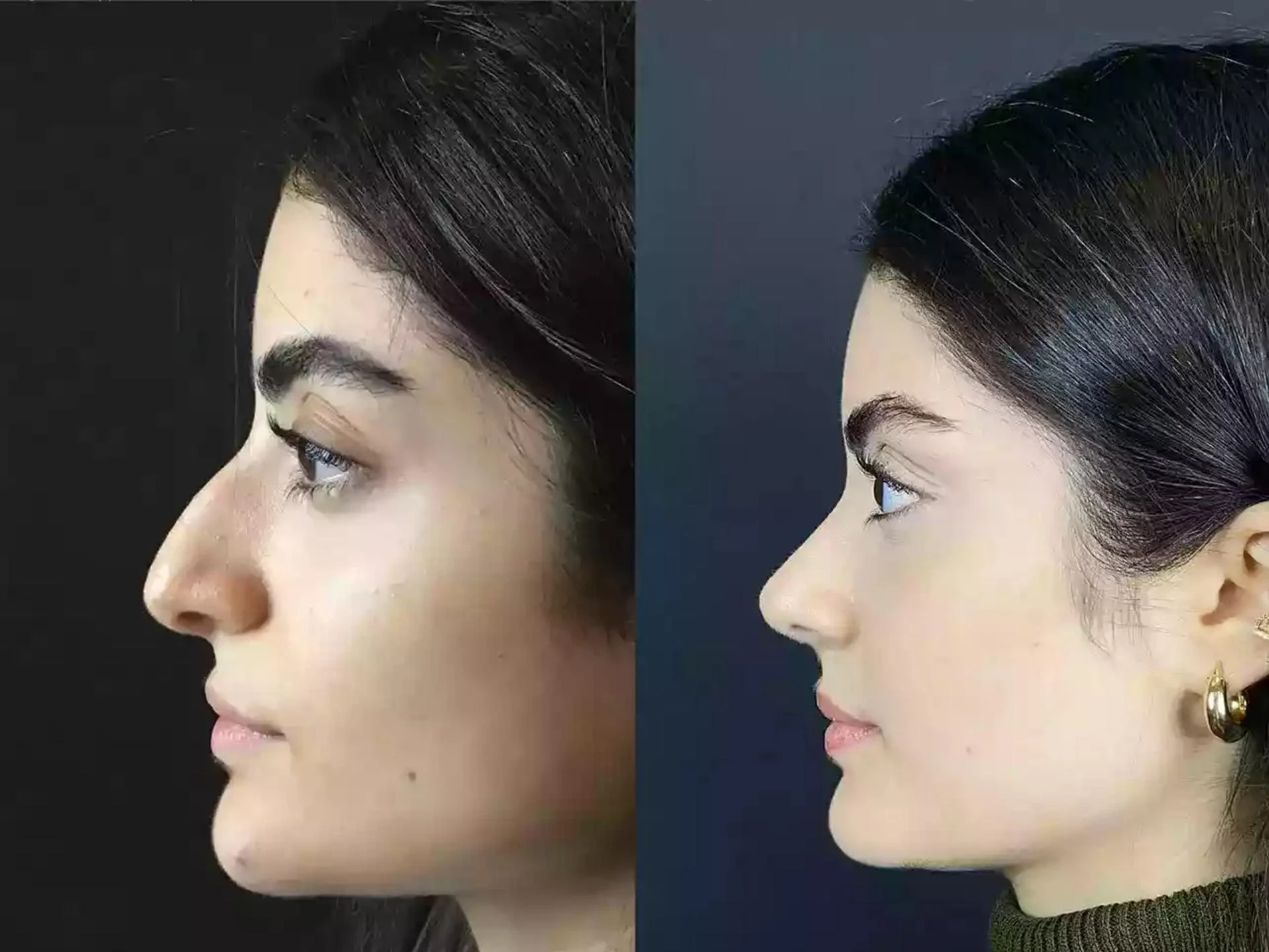 Nose Surgery in Dubai: Functional vs Corrective Procedures