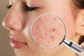 Comprehensive Guide to Acne Treatment: Strategies for Clearer Skin