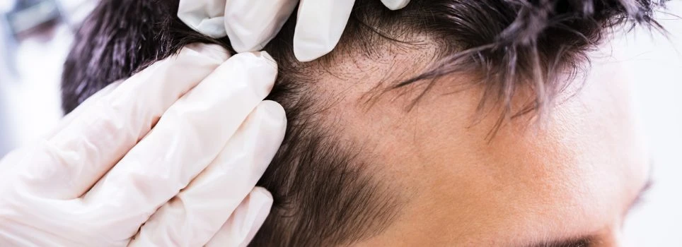 Restoring Confidence: Finding the Right Hair Transplant Clinic in Islamabad