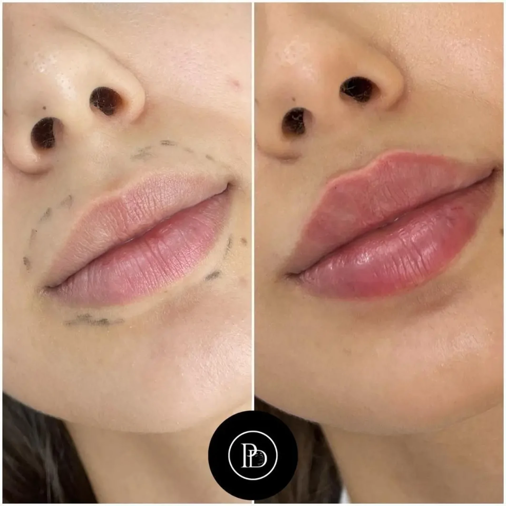 Juvederm Volbella Treatment Overview at the Best Aesthetic Clinic in Dubai