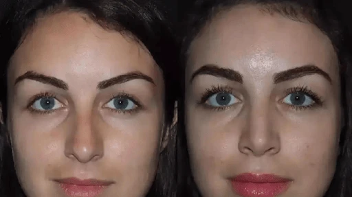 Advanced Nose Surgery with the Best Rhinoplasty Surgeon in Dubai