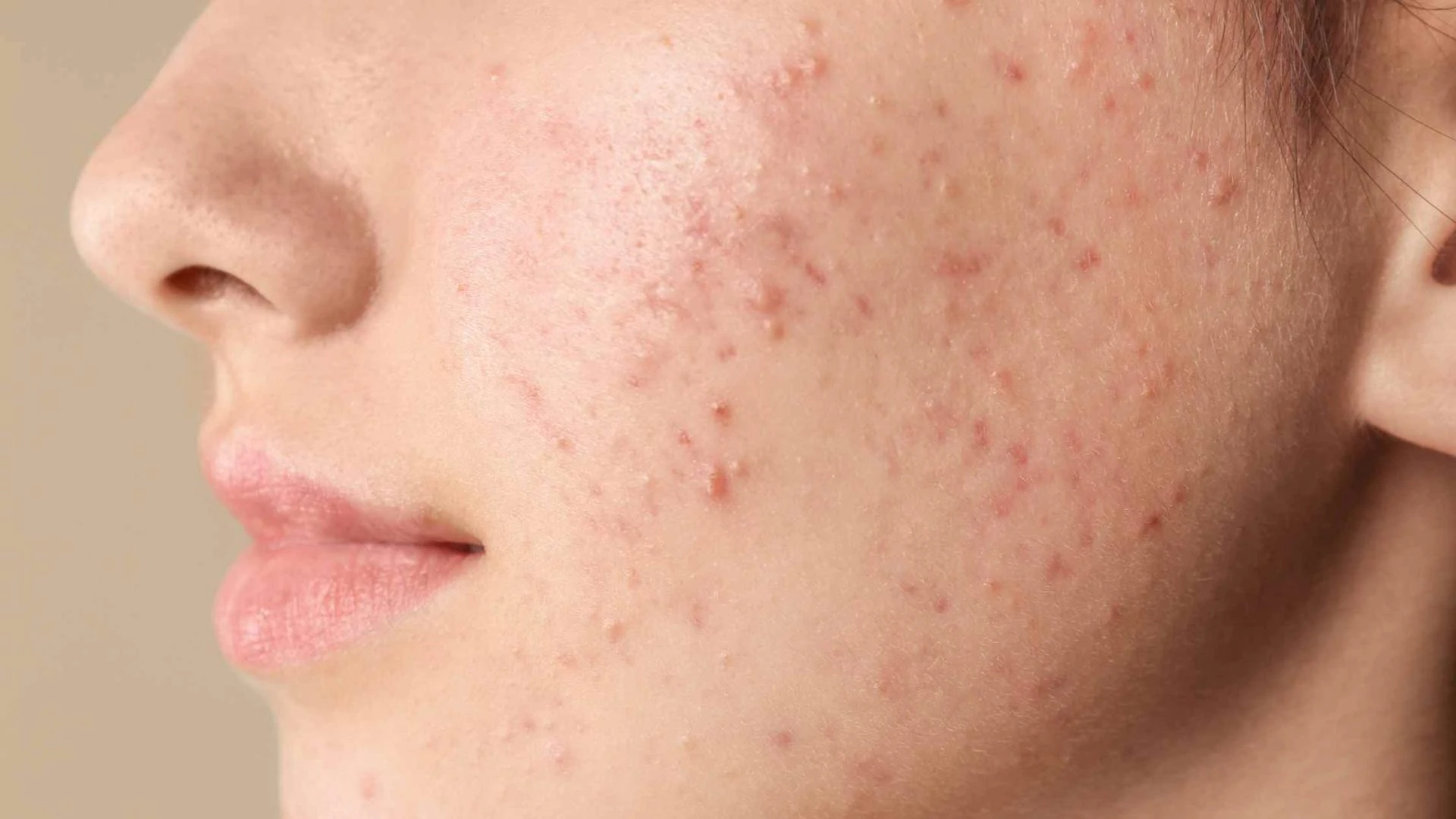 Is Acne Scar Laser Treatment Delhi the Right Solution for You?