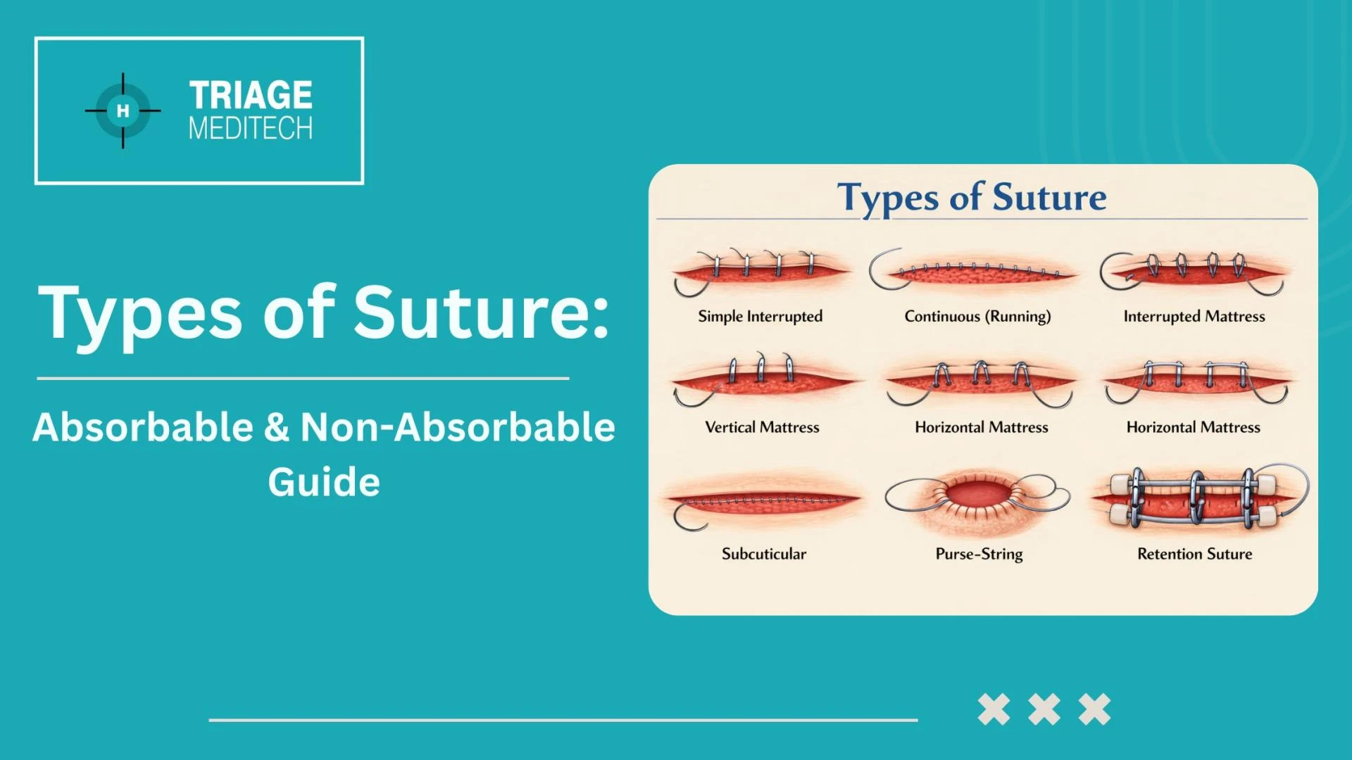 Type of Suture: A Complete Clinical Guide to Suture Materials and Techniques