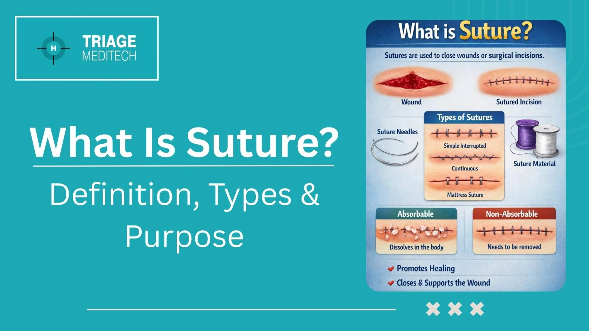 What Is Suture? Meaning, Types, Uses, and Healing Process Explainedtle