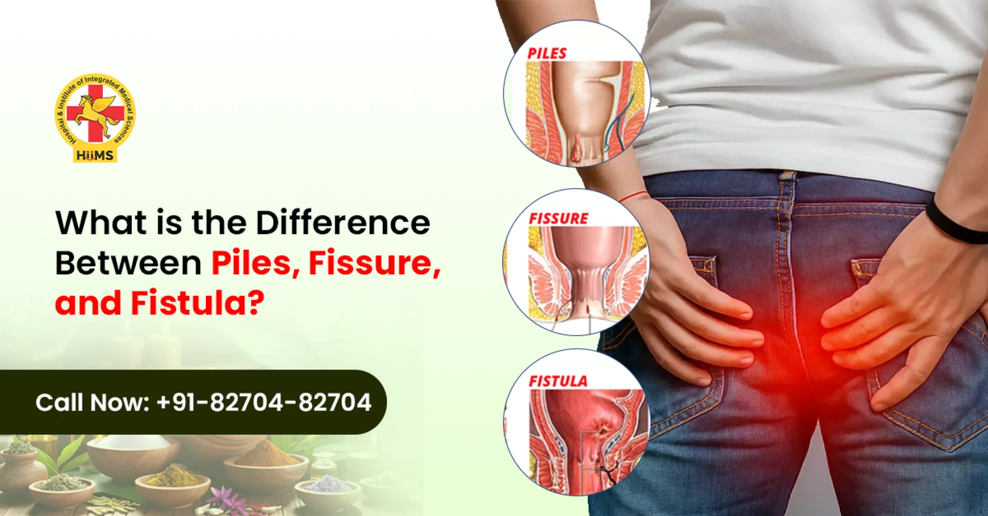 Piles vs Fissure vs Fistula: Symptoms, Causes, and Treatment Insights