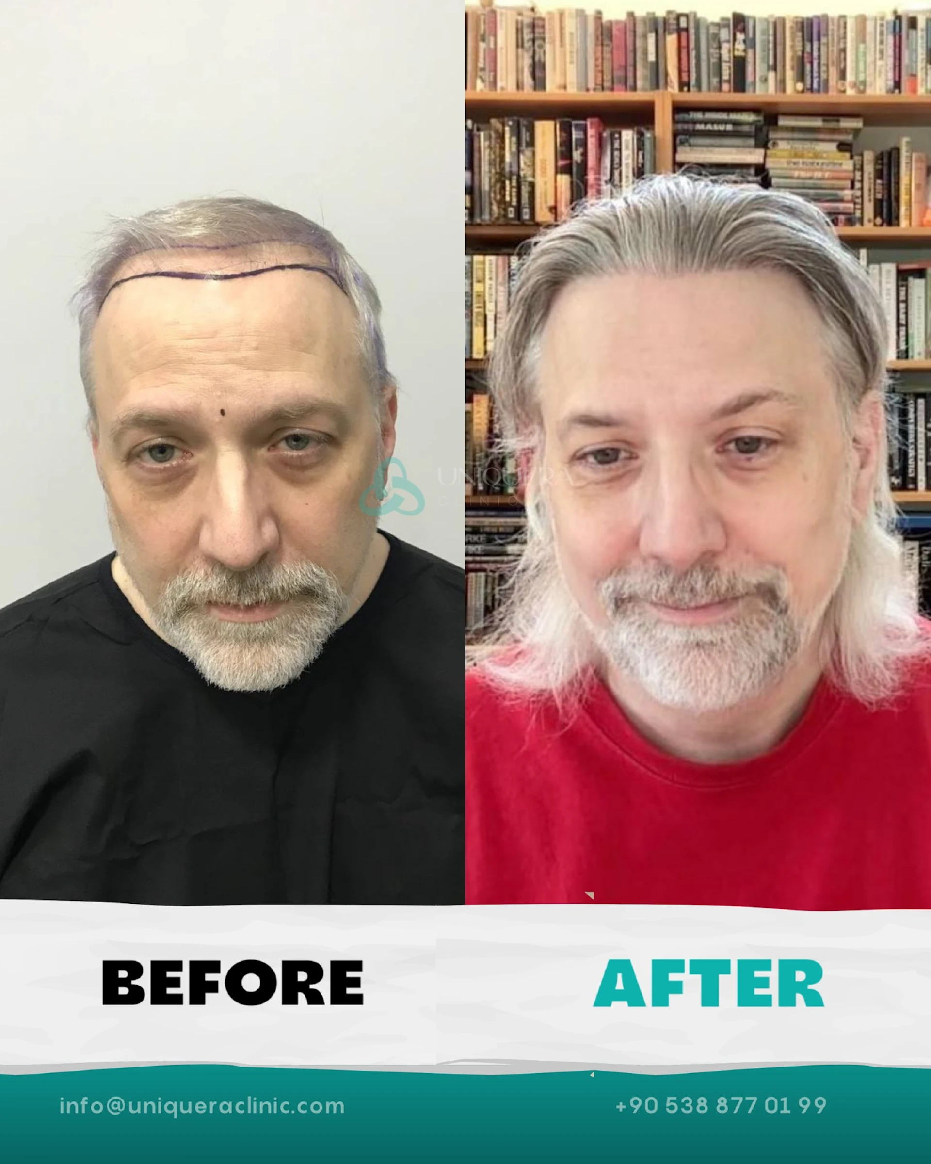 How Age Impacts Hair Transplant Surgery Success