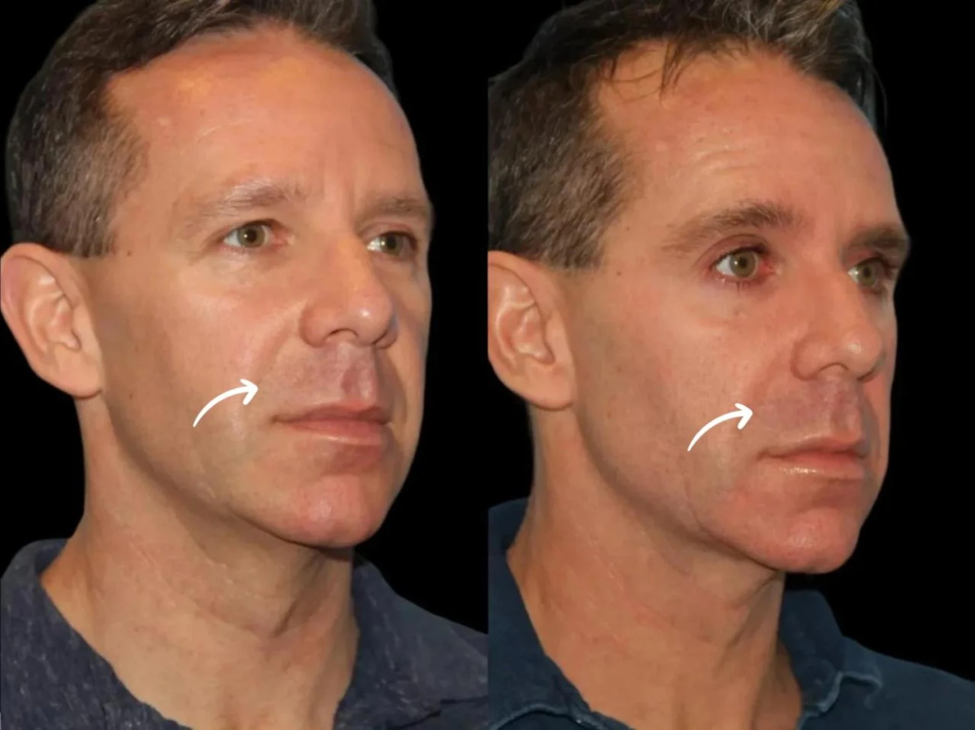 Why Men Choose Sculptra Treatment in Dubai