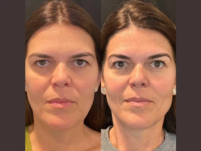 Age-Wise Guide to Thread Lift Treatments in Dubai