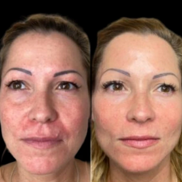 Best Doctors in Dubai for Structured Profhilo Treatment Safety