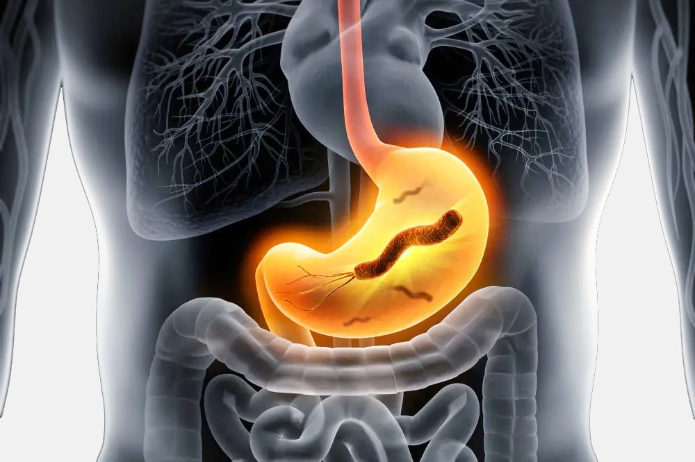 Stomach Infection: Causes, Symptoms, and How It Affects Your Digestive System