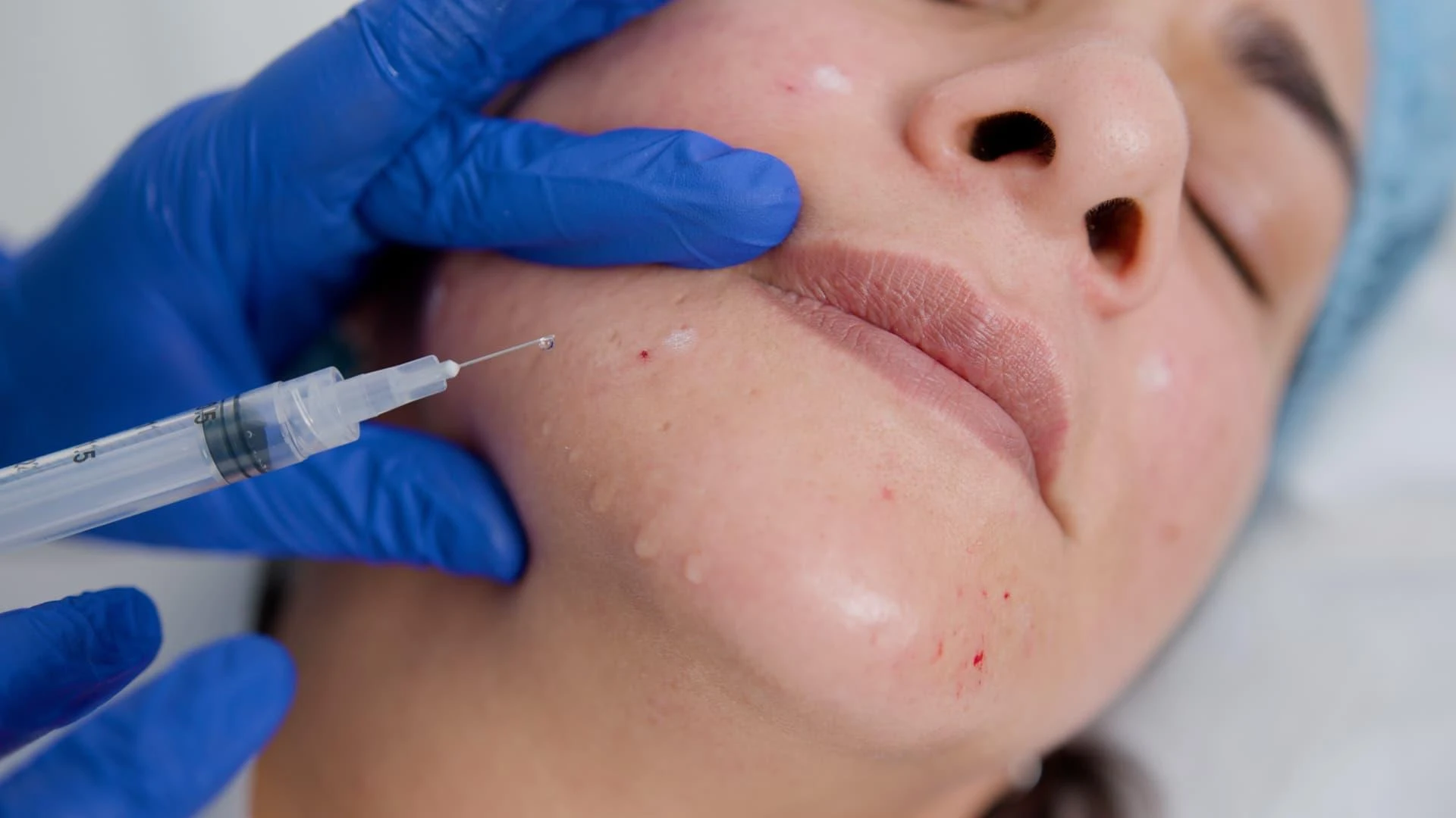 How Mesotherapy Supports Natural Skin Glow