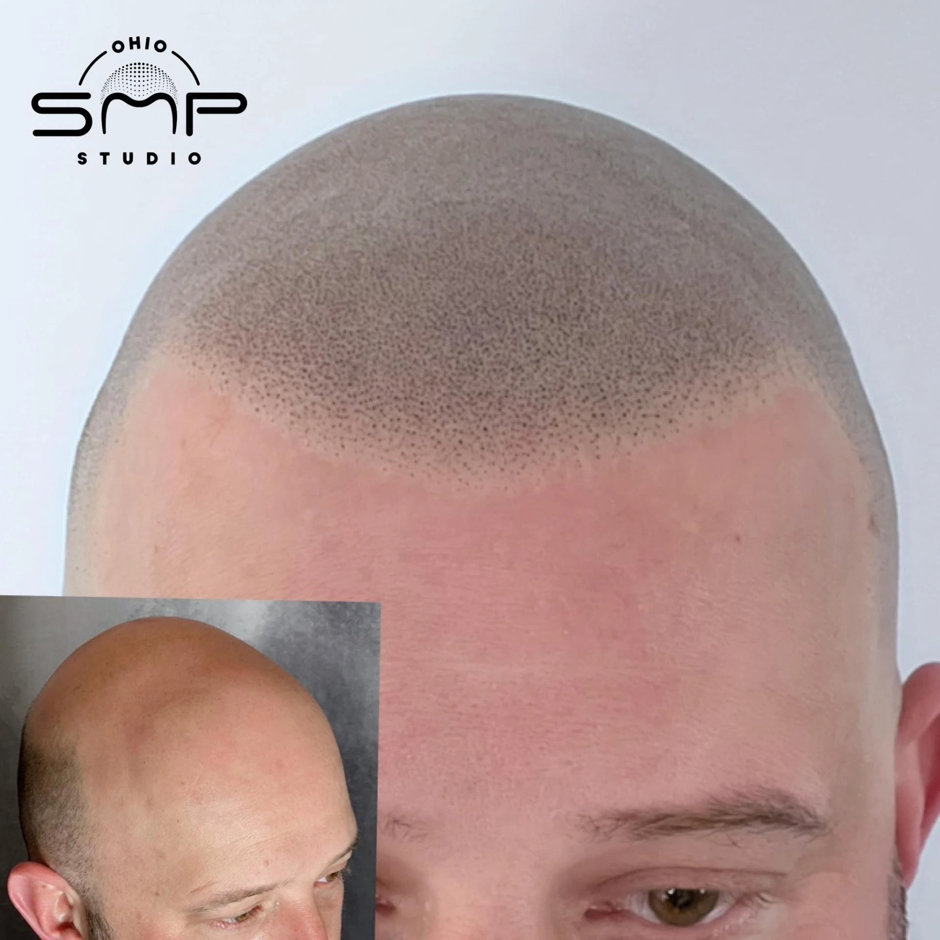 Scalp Micropigmentation: The Perfect Blend of Art and Science