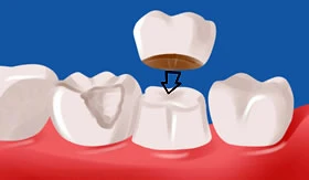 A Complete Guide to Toronto Dental Crown Treatment