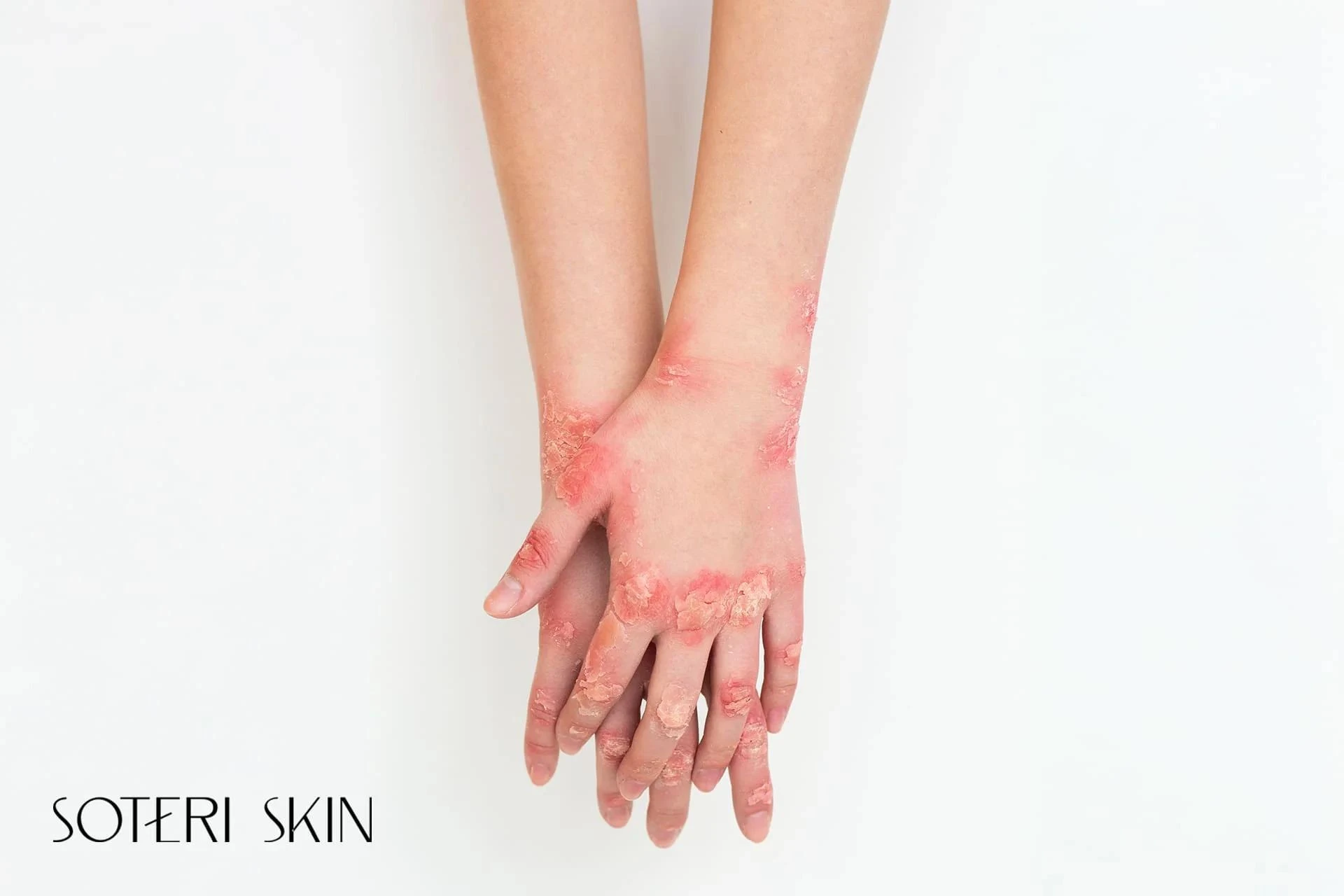 Eczema or Psoriasis? How to Tell the Difference and Manage Symptoms