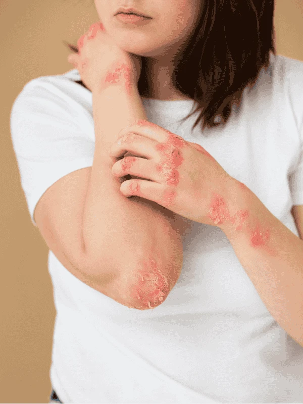 What Are the Best Options for Psoriasis Treatment In Mumbai