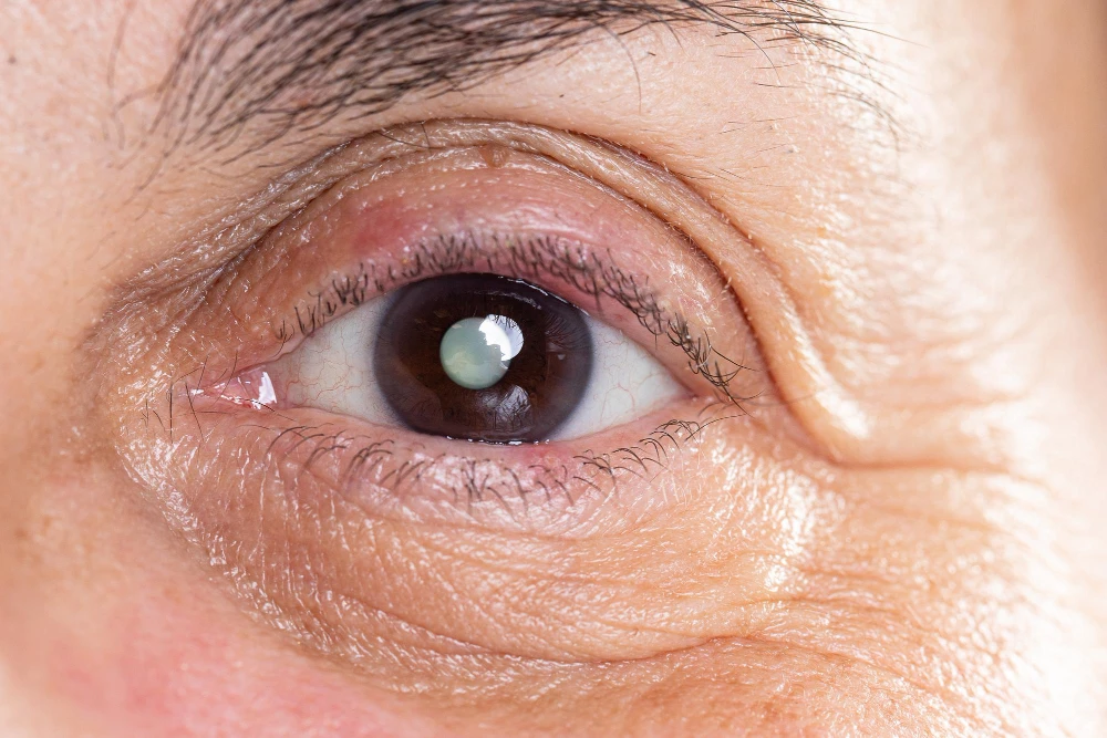 Cataract Fundamentals: Recognizing Symptoms and Seeking Treatment