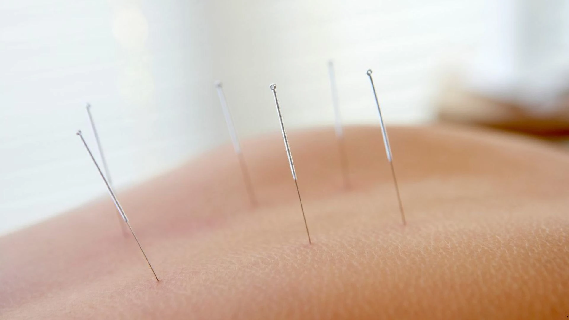 A Simple Guide to Acupuncture: Benefits, Uses, and What to Expect