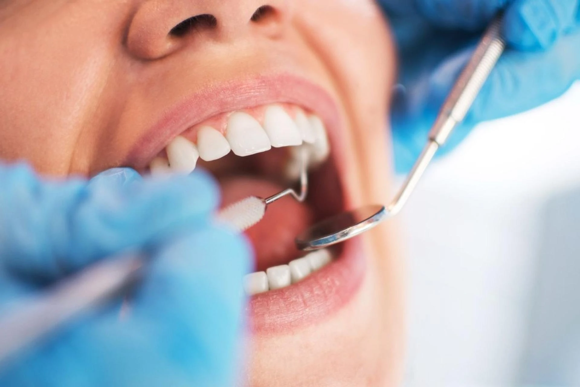 White Dental Fillings Explained: Composite Resin for Natural Smiles!